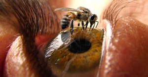 Bee-Sting-Treatment-at-Exer-More-Than-Urgent-Care